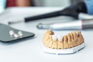 manufacture of veneers, dental implants and crowns in the dental laboratory.