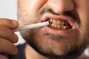 A man with bad teeth and herpes on his lip holds a cigarette near his mouth, which is much whiter than his teeth